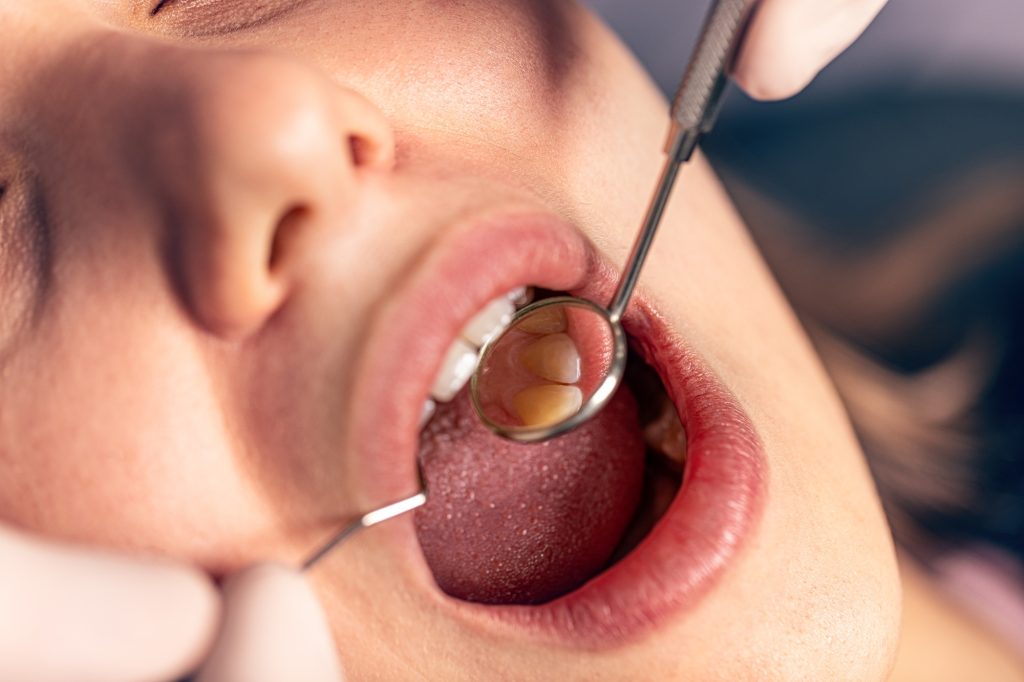 Dentist examining gums for early signs of gum disease
