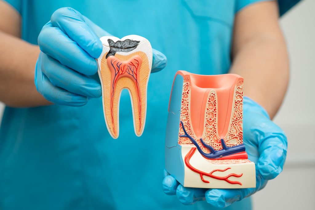 Close-up of tooth decay showing cavity progression
