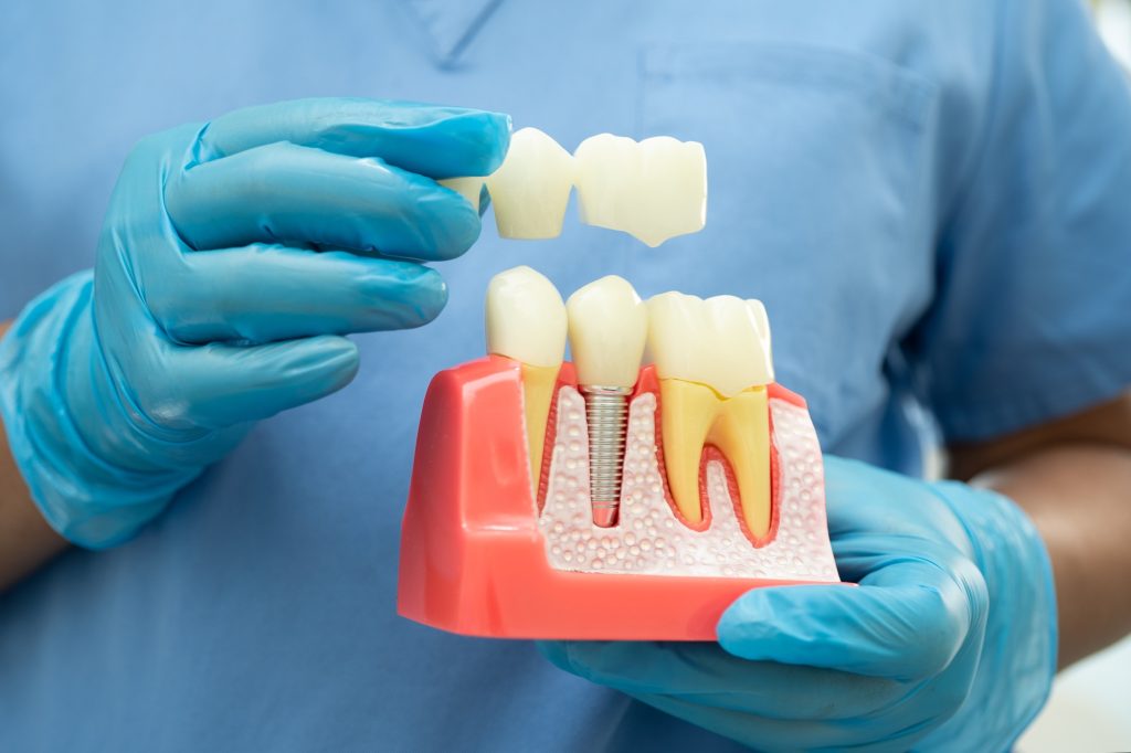 Dental bridge and dental implant tooth replacement options